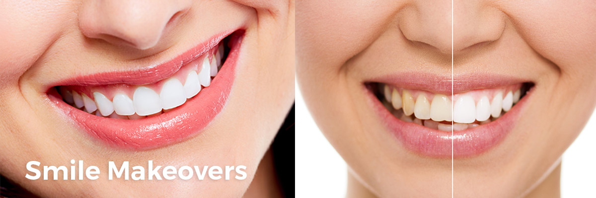 teeth cleaning hounslow