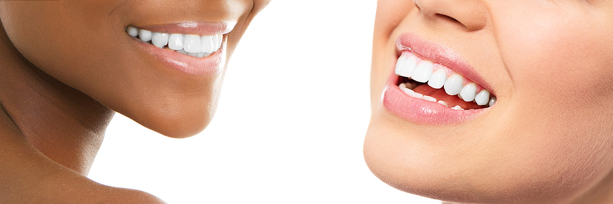 teeth whitening hounslow