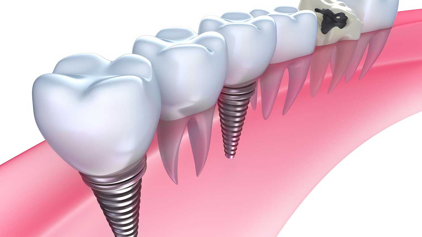 dental implants nhs