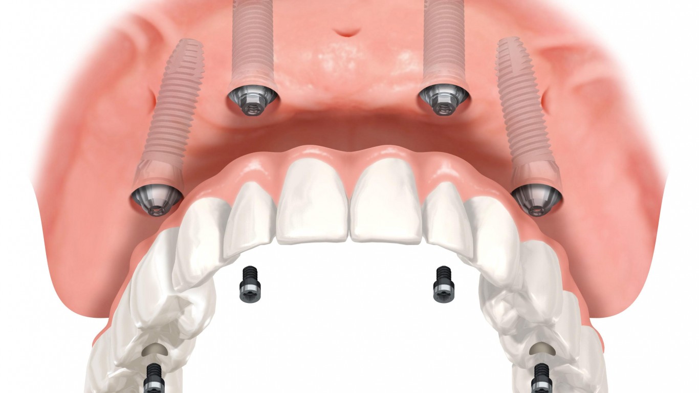 full mouth dental implants Heston, Hounslow