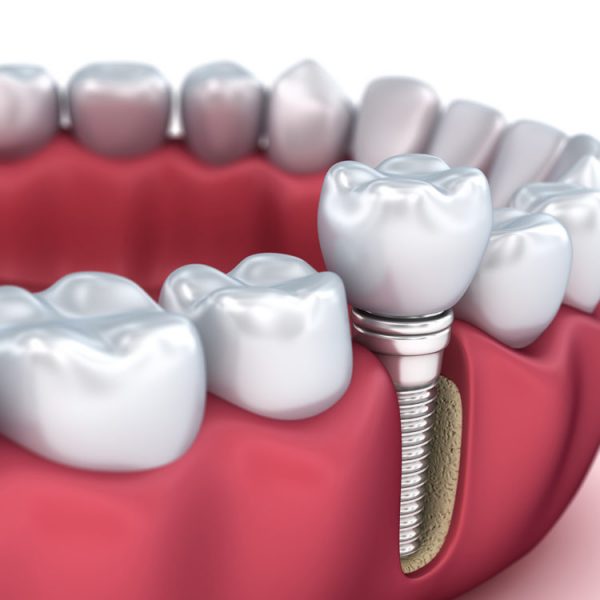 Dental Implants Hounslow | Implant Specialist | NHS & Private Care