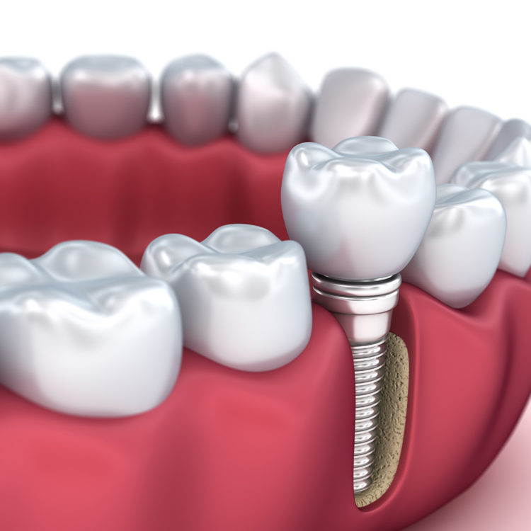 dental implants hounslow